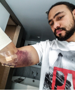 KeithThurman_elbow